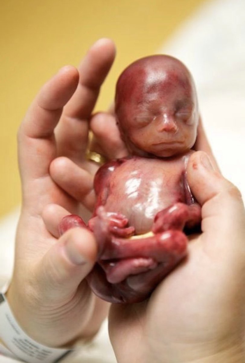 ¿Y pensar que hay gente que dice que esto no es un ser humano? Es la goto de un feto abortado de 16 semanas. La verdad es que a mi me parece un ser humano. ¿ y a ti?