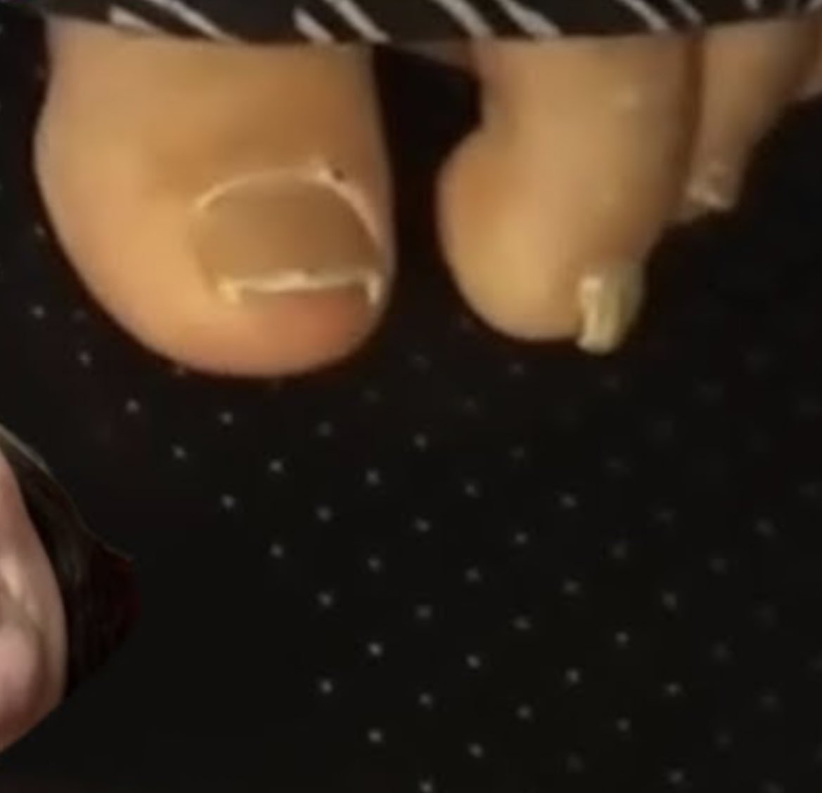 CPAPProtection's tweet photo. @ChantalRoomate @Not_That_Katie ALR’s toes for reference https://t.co/LK3u1u9q6y