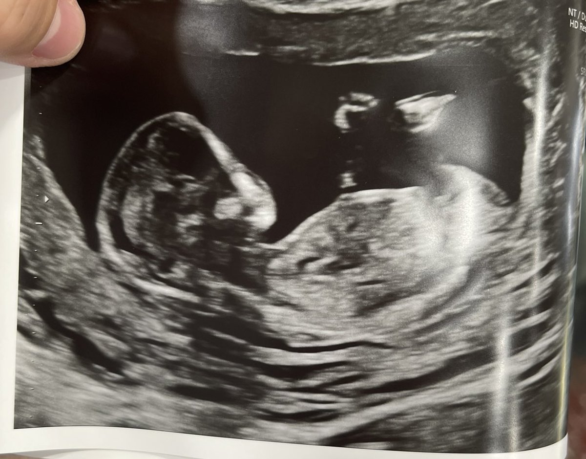 LucasDunker1's tweet photo. God has blessed Julia and I with a baby boy on the way! Baby dunk July 2023❤️ https://t.co/vSIinQEI0V