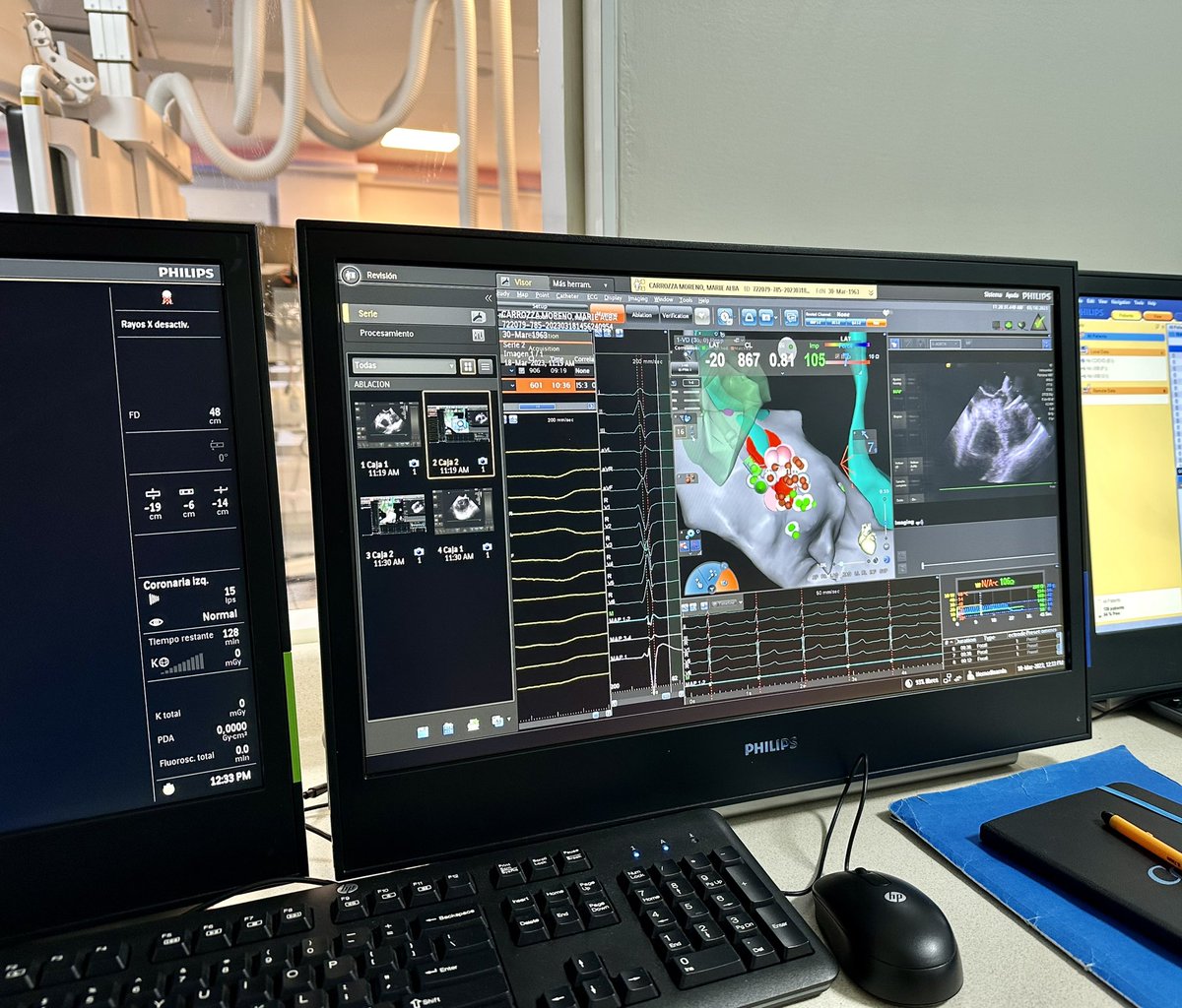 OscarVazquezEP's tweet photo. Last one before (a well deserved) vacation. LV summit PVCs. #ZeroFluoro #EPeeps #EPLife #Carto3 https://t.co/qlt4GFgvnL