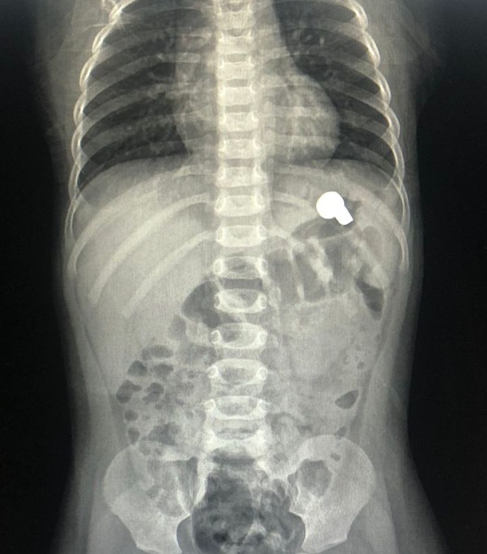 IvonneMerlos's tweet photo. ⚠️ ATENCIÓN! 
Niña, 1 año 4 meses, rompe un juguete, ingiere de forma accidental 2 de las 3 baterías que traía el aparato, en 15 horas causó daños importantes . Causan erosiones por la corrosión y alto riesgo de perforación.  EVITEN JUGUETES CON BATERIAS EN NIÑOS PEQUEÑOS! https://t.co/lvgI8Wz9jS