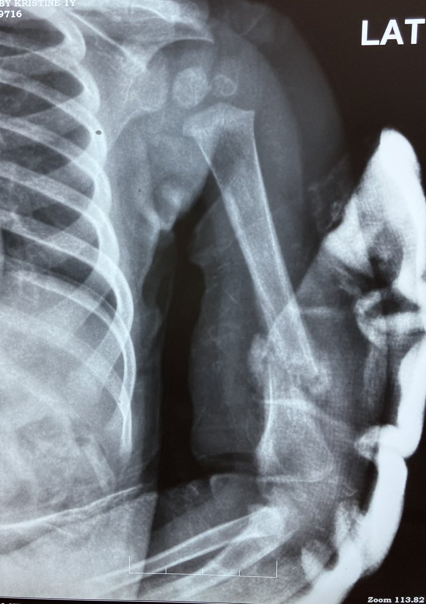 A 6 month girl child with humerus fracture. Showing signs of healing within the end of second week. Had to spend a lot of time with the parents to convince them that this is ok. #handsurgery