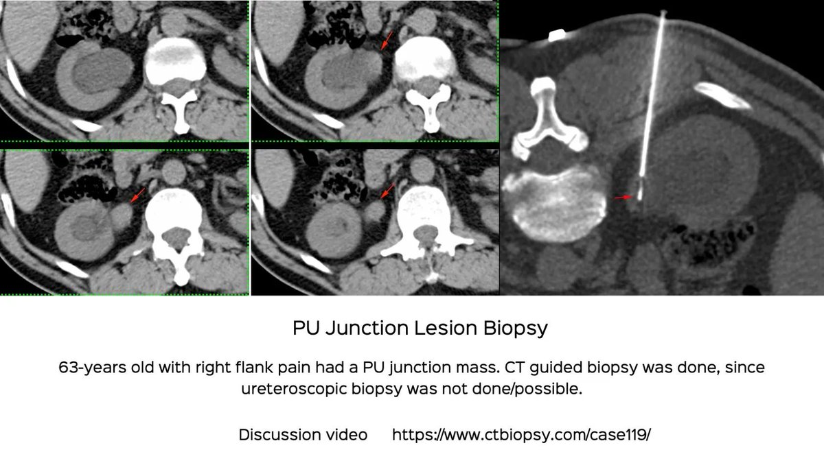 Case 119: Pelvi-ureteric junction (PUJ) Mass Biopsy

These are easy to do percutaneously. 63-years old man.

Discussion and video 
ctbiopsy.com/case119/

#ctbiopsy #irrad #pelviuretericjunction #PUJ #urothelialcarcinoma