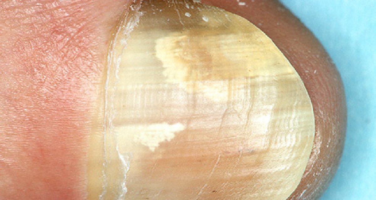 MD on Twitter "Tiny fungi can get inside your nail through a crack or break, causing an