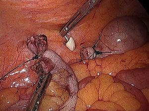 Paciente 👦🏻 41 a ➡️ intervención por #apendicitis  ➡️ clínica típica de 48h

Al seccionar la base se encuentran el cuerpo extraño de la imagen🦷¿Te ha pasado alguna vez? 

🔗elsevier.es//es-revista-ci… 

<a href="/StcuaeC/">AECUrg</a> <a href="/me4_so/">SoMe4Surgery</a> <a href="/aecirujanos/">aecirujanos</a> <a href="/marinavilatura/">Marina Vila</a> <a href="/CSdMaresme/">Consorci Sanitari del Maresme</a> #CirEsp #emgensurg
