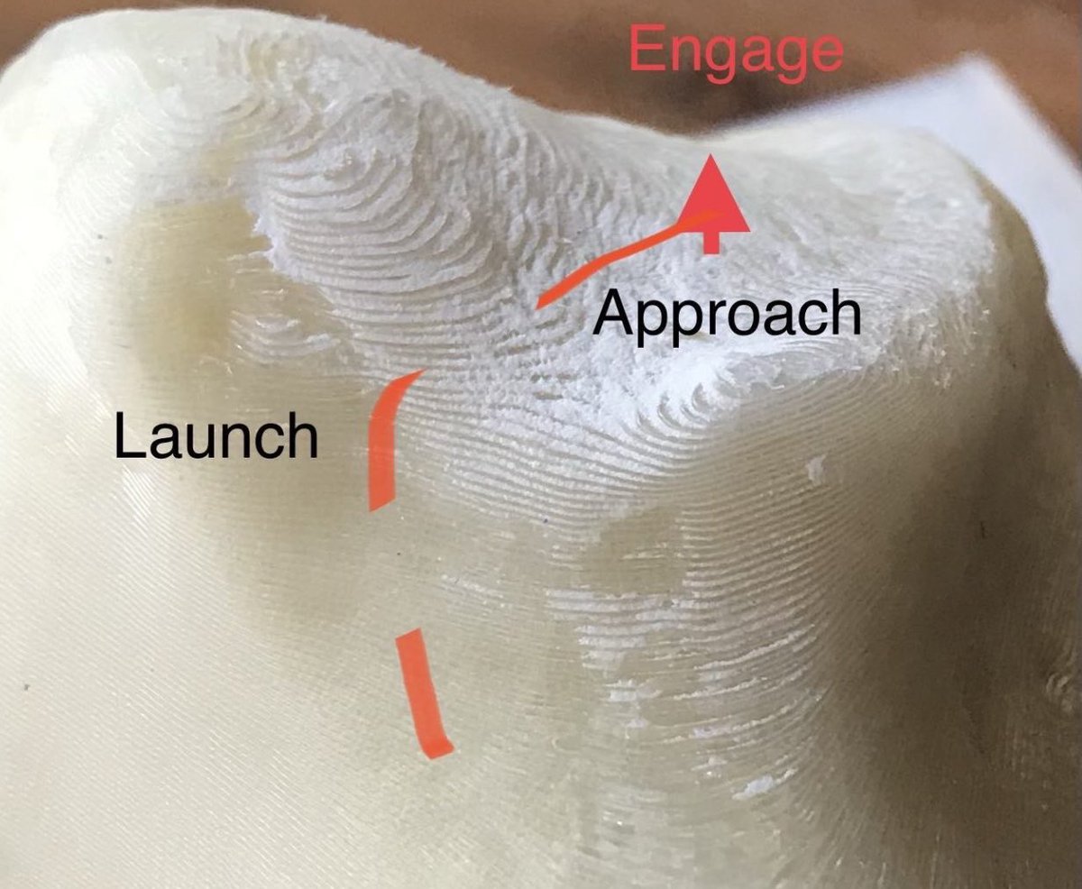 Trochlea dysplasia is hard to understand with 3-D imaging and prints. How can one possibly understand it well enough to make consistently optimal decisions about surgery using 2-D only?  See Yu and Beitler open access in Arthroscopy Techniques