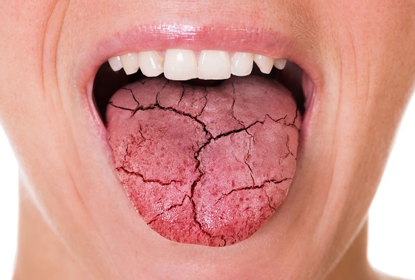 Dry mouth is the feeling there is not enough saliva in your mouth. If you have a dry mouth all or most of the time, the cause may be a serious health condition. Learn more about symptoms, causes and treatments: ow.ly/jk9F50NlK1w #DryMouth
