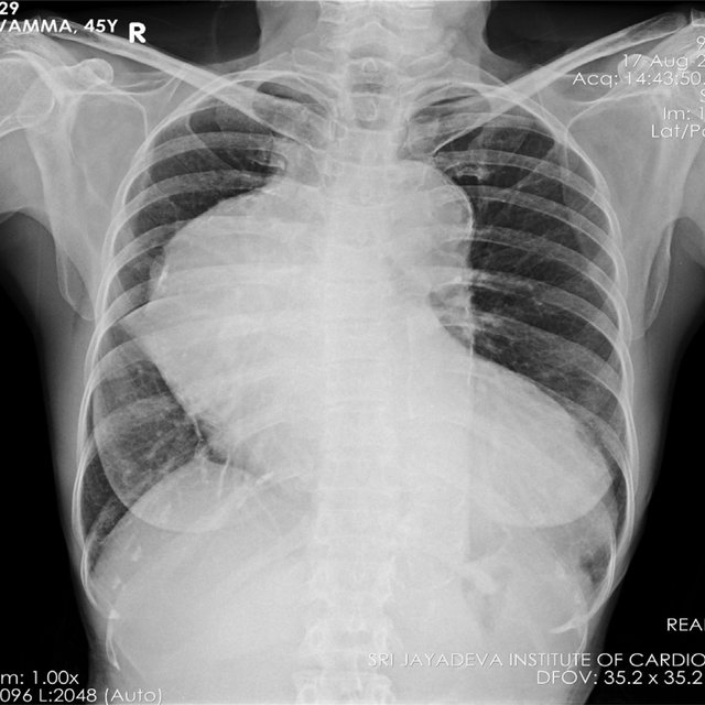 Sthanu on Twitter "45year old female patient presented with dyspnoea