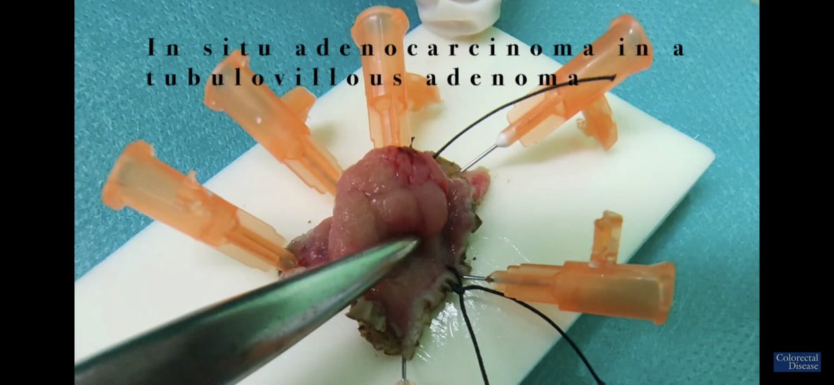 Colorectal Disease (@colorectaldis) on Twitter photo 🎁#CodiSundays 🎁
<a href="/escp_tweets/">European Society of Coloproctology</a> & <a href="/colorectaldis/">Colorectal Disease</a> look at:
🤖Robotic TAMIS🤖
🔗link🔗
youtu.be/mm9QSnGQ3u8
#SoMe4Surgery #colorectalsurgery 🎁#CodiSundays 🎁
<a href="/escp_tweets/">European Society of Coloproctology</a> & <a href="/colorectaldis/">Colorectal Disease</a> look at:
🤖Robotic TAMIS🤖
🔗link🔗
youtu.be/mm9QSnGQ3u8
#SoMe4Surgery #colorectalsurgery