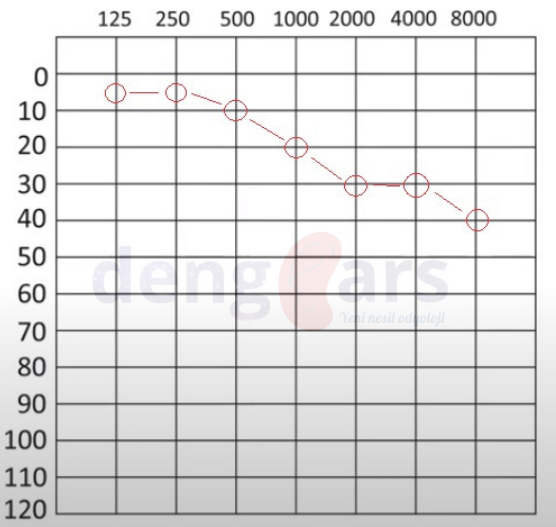 dengears_'s tweet photo. Slopping konfigürasyonu; alçak frekanslarda işitmenin normal olup, yüksek frekanslara doğru azalmasıdır.

#hearing #audiology #audiogram #odyogram https://t.co/WYAbx0VETR
