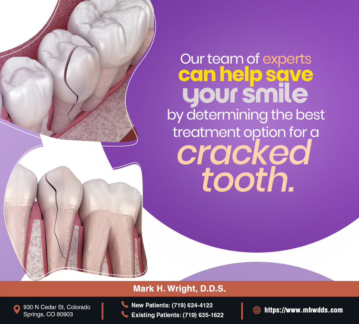 markhwrightdds's tweet image. A cracked tooth can cause sudden pain and other symptoms. If you suspect you have a cracked tooth, speak to us at (719) 624-4122, and we will determine suitable treatment to save your tooth. #crackedtooth #markhwrightdds #coloradosprings #CO