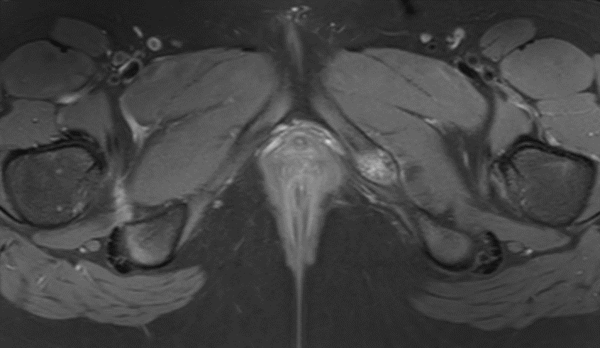 mskteachingroom's tweet photo. What is this "do-not-touch" lesion? 

#radfellow #radiologyfellow #radiologyresident #learningradiology #radres #mskrad #radtwitter #radiology #transformingradiology #mri https://t.co/HY4xxTY9Kd