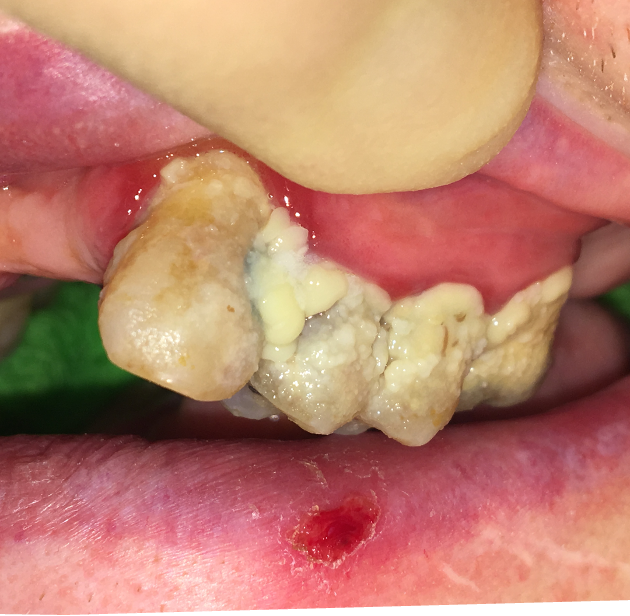 MCM_HEKSS's tweet photo. #WOHD2023Why does #Mouthcarematter?A mouth full of plaque, fooddebris &amp; secretions can lead to inflammation in the mouth, pain &amp;disease. This can lead to problems eating, drinking,speaking &amp; impact patient dignity. If we had plaque on our hands, would we wash them before we eat? https://t.co/t4ApekvGE6