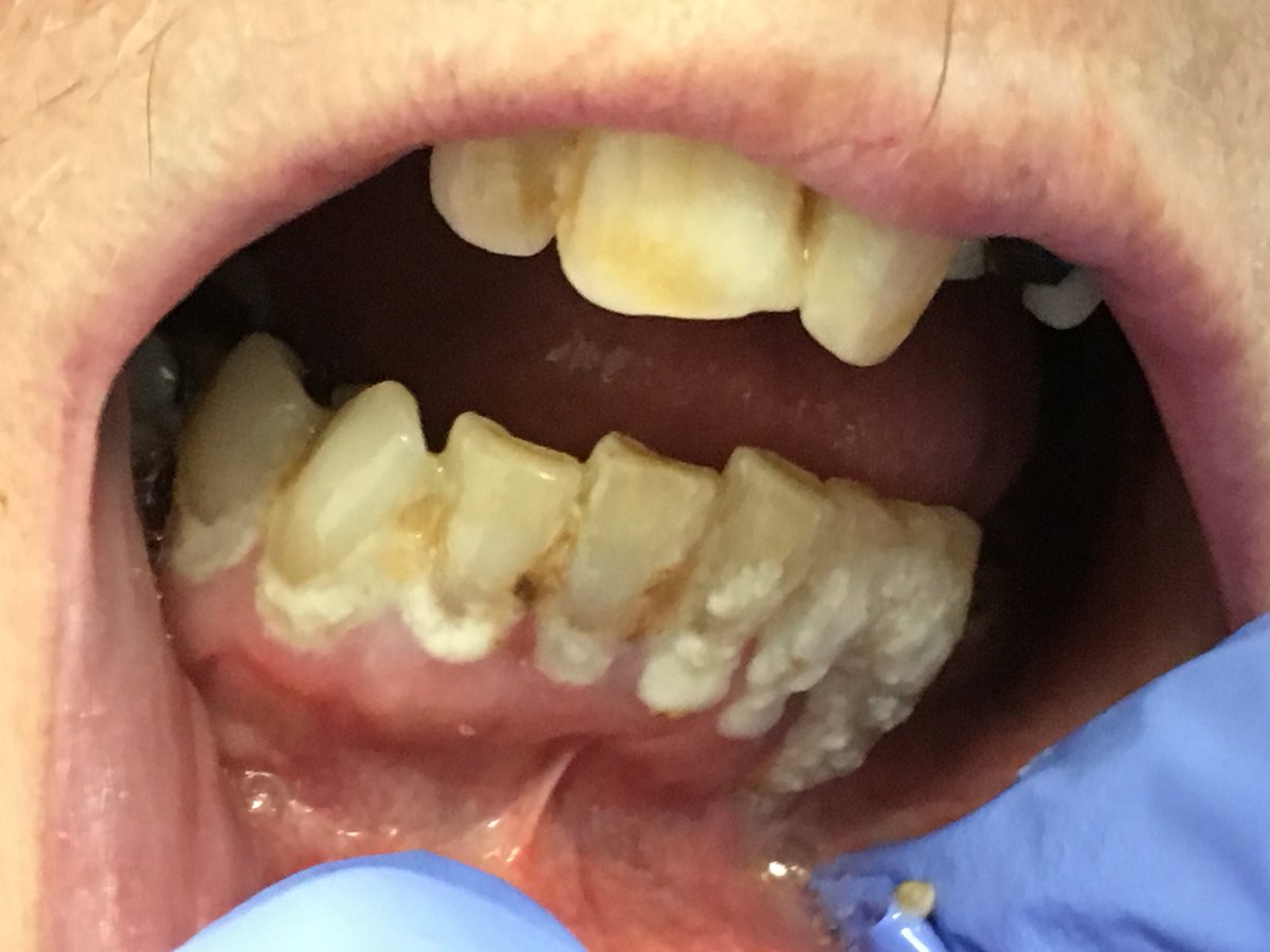 Today is #Worldoralhealthday, let's use this opportunity as a reminder of the importance of #mouthcare for people of all ages in all settings #hospitals #carehomes #ownhomes <a href="/Mini_MCM/">@Mini_MCM</a>