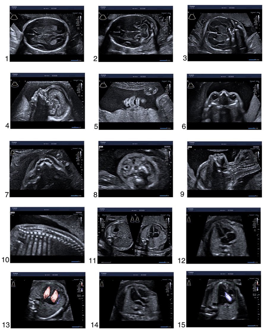 How to do a second trimester anomaly scan @karloliverkagan #pregnancy #secondtrimester #fetalscan link.springer.com/content/pdf/10…