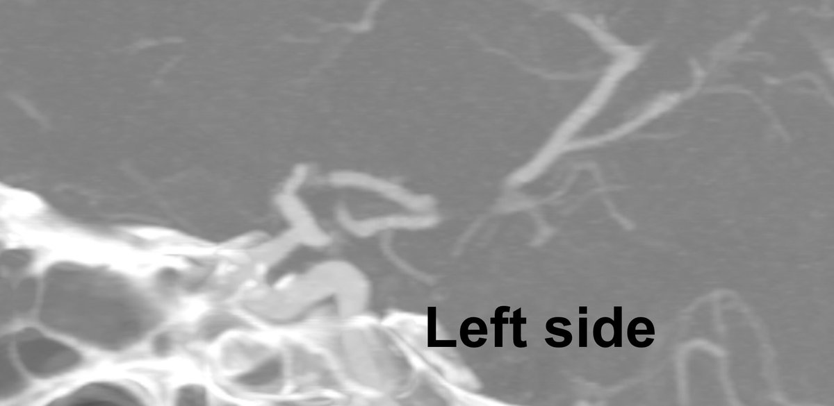 1.
Medical H: 61y.o Smoker and HTN. Aneurysmatic SAH family history. Incidental finding without symptoms.
AngioCT + MRI: Bilateral PCoA aneurysms

<a href="/FuatArikan/">Fuat Arikan</a> <a href="/vallhebronpath/">VallHebronPath</a>