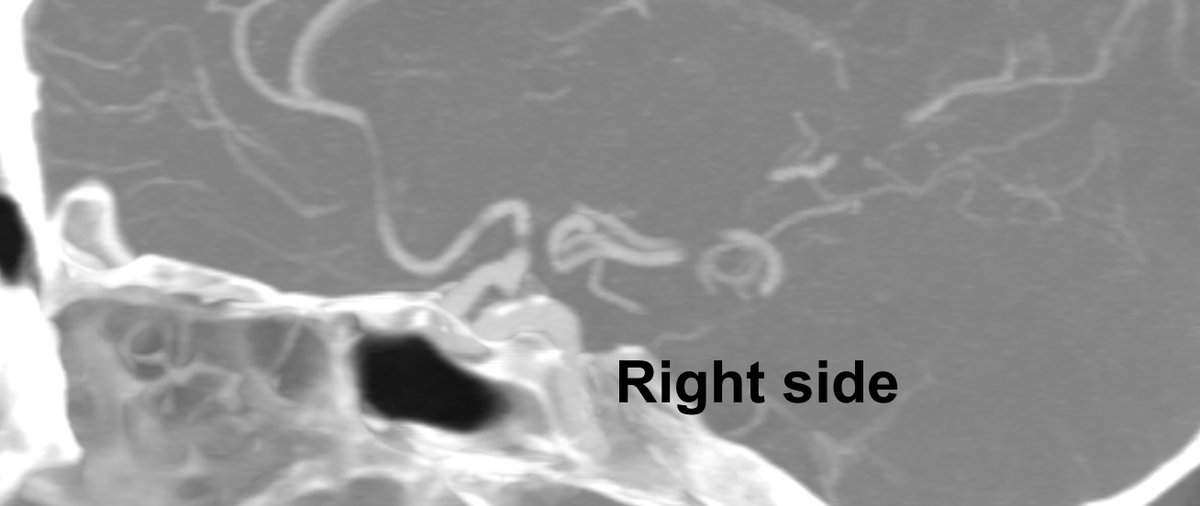 CarlosSantosJi3's tweet photo. 1.
Medical H: 61y.o Smoker and HTN. Aneurysmatic SAH family history. Incidental finding without symptoms.
AngioCT + MRI: Bilateral PCoA aneurysms

@FuatArikan @vallhebronpath https://t.co/oAZ5uVDDfs