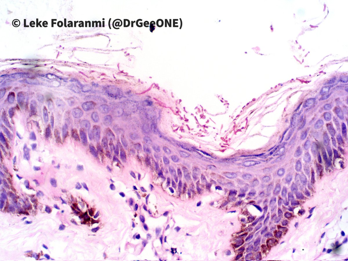 DrGeeONE's tweet photo. 1/4
My thread of #SpecialStainsInPathology inspired by @VijayPatho
Superficial mycosis 
1. PAS
2. GMS
#Dermpath #pathology
#CrittersOnTwitter https://t.co/P3WYNr3nSV