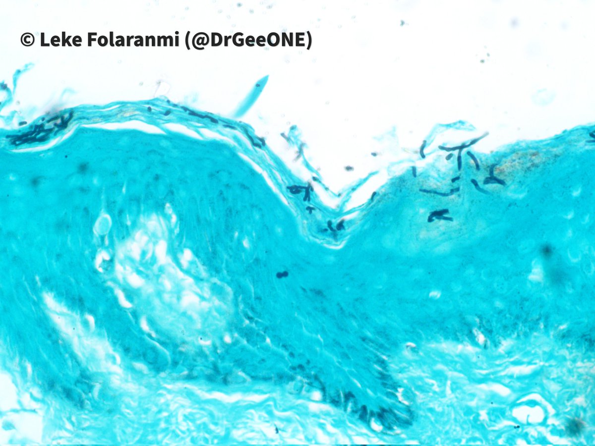 DrGeeONE's tweet photo. 1/4
My thread of #SpecialStainsInPathology inspired by @VijayPatho
Superficial mycosis 
1. PAS
2. GMS
#Dermpath #pathology
#CrittersOnTwitter https://t.co/P3WYNr3nSV