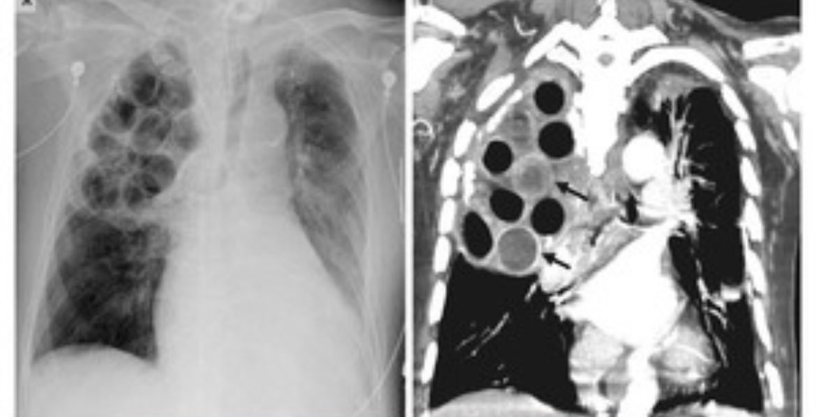 OGdukeneurosurg's tweet photo. 86-yo man hospitalized for repeated episodes of septic shock due to MRSA pneumonia. What is going on? @NEJM https://t.co/UlYOMAPGrf