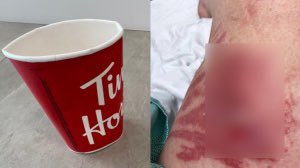 canadafeed_'s tweet photo. Ontario woman suing Tim Hortons for $500K after hot tea spill left her 'disfigured' https://t.co/TFdRkM5VcQ