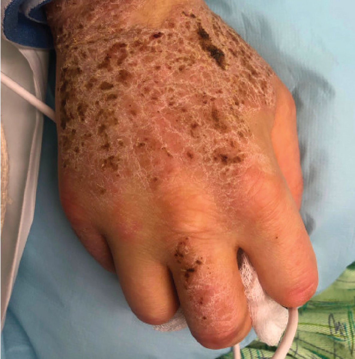 drkeithsiau's tweet photo. Patient with chronic alcohol excess presents with this generalised rash. What’s the diagnosis? https://t.co/OKqKGLkH1r