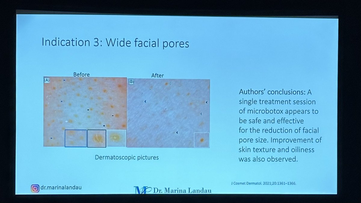 A great pearl from today at the AAD 2023 in NOLA, the use of microbotox is effective for the reduction of facial pore size 😍 #AAD2023challenge #AAD2023