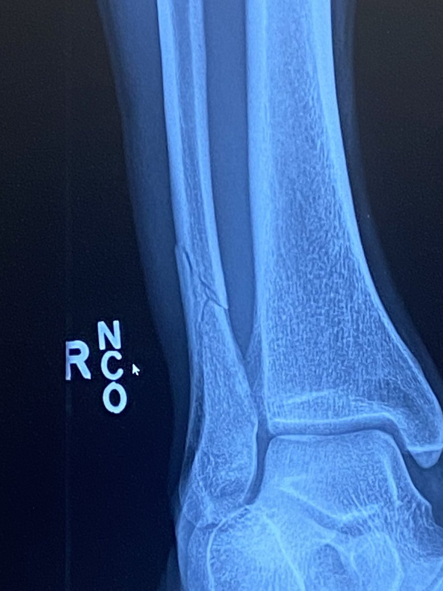 thehpcpodcast's tweet image. Sask Tough. 
@JordonM40 helps @RedversRockets take a 2-0 lead in the Big Sexy league finals, finishes game on a fractured fibula, gets the POG bucket. 
#hpcbump 

@MondayNooner @SaskForum