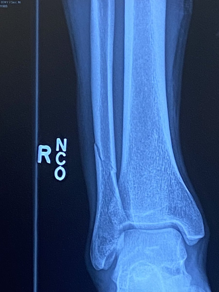 thehpcpodcast's tweet image. Sask Tough. 
@JordonM40 helps @RedversRockets take a 2-0 lead in the Big Sexy league finals, finishes game on a fractured fibula, gets the POG bucket. 
#hpcbump 

@MondayNooner @SaskForum