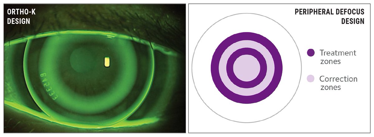 revoptom's tweet photo. Ortho-K, Multifocal Contacts Offer Similar Progression Halting Effects
Retrospective analysis found no difference in the annualized axial length growth with these types of myopia control options.

https://t.co/WpICL3VldY

#myopia #myopiacontrol #eyecare #optometry #vision https://t.co/pVzup14OSK