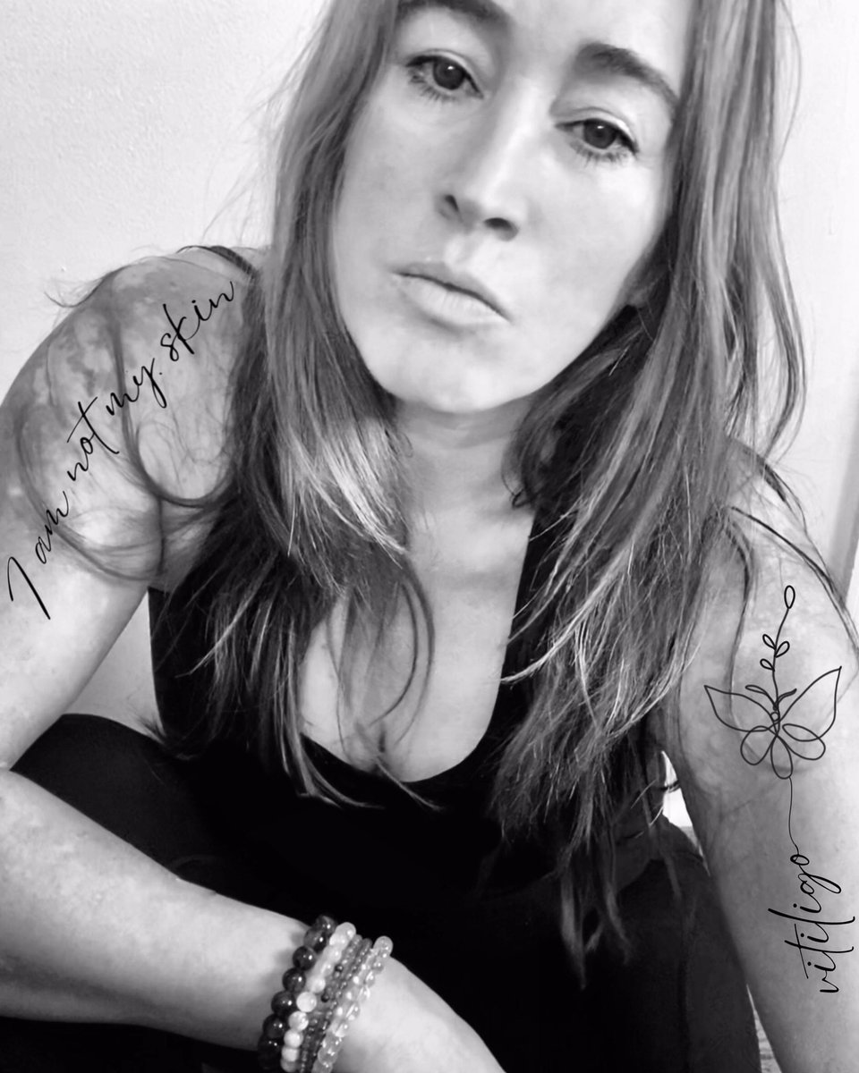 My skin tells a story of strength, resilience &amp; courage. Each patch, spot, line is a reminder of what I've overcome &amp; what I'm capable of. I refuse to be defined by my skin, because I am a force to be reckoned with. My skin is just one small piece of my powerful self🌱 #vitiligo