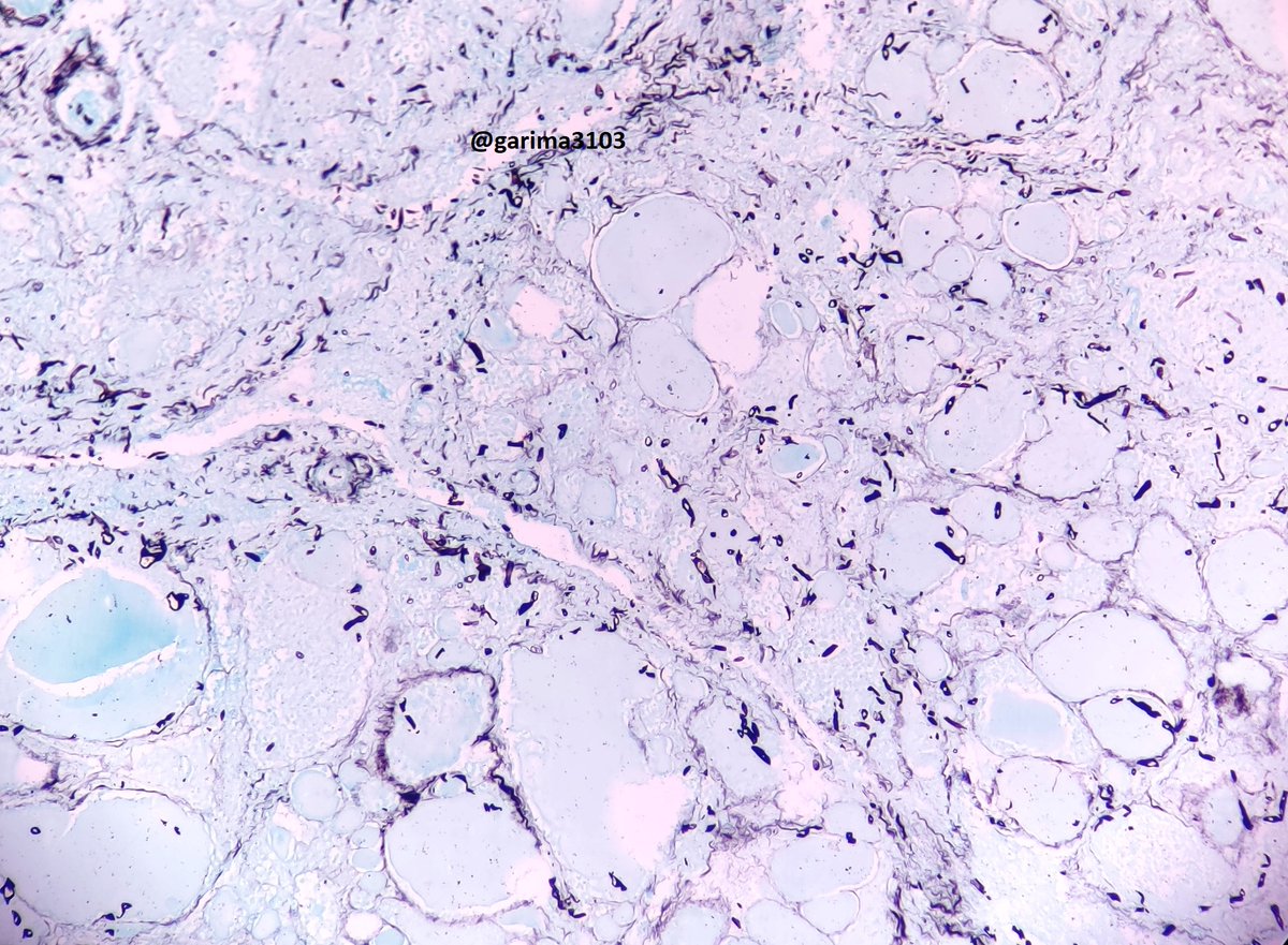 2/3 Thyroid mucor in a patient post Rx Tx