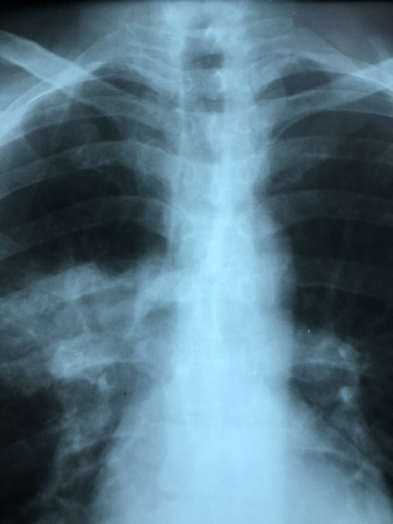 AminaBenyoucef5's tweet photo. I learned from the Miller’s Anesthesia that the size of DL tube is more predictable through the radiography than the anthropological pt’s characteristics.
Here’s an exemple : 1m60 that needed a 41 Fr
@bobfunn @AirwayMxAcademy @HouthoffKavita https://t.co/pu3BPuHkZI