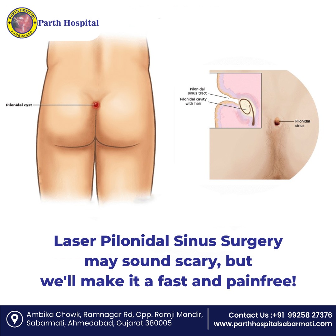 parthhospital06's tweet image. Laser Pilonidal Sinus Surgery may sound scary,
but we&apos;ll make it a fast and painfree!

Consult expert at Path Hospital for Pilonidal Sinus Surgery in Ahmedabad.

#ParthHospital #pilonidal #pilonidalsurgery #pilonidalsinus #lasersurgery #gastroenterologist #gastroenterologist
