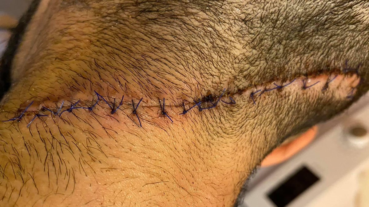 2021: This is what happens when you criticize Ilham Aliyev and his wife Mehriban Aliyeva. You going to get shot at, and if it fails they going to blackmail you with your sister’s intimate video. When neither shooting nor blackmailing  work, they have you stabbed no matter where