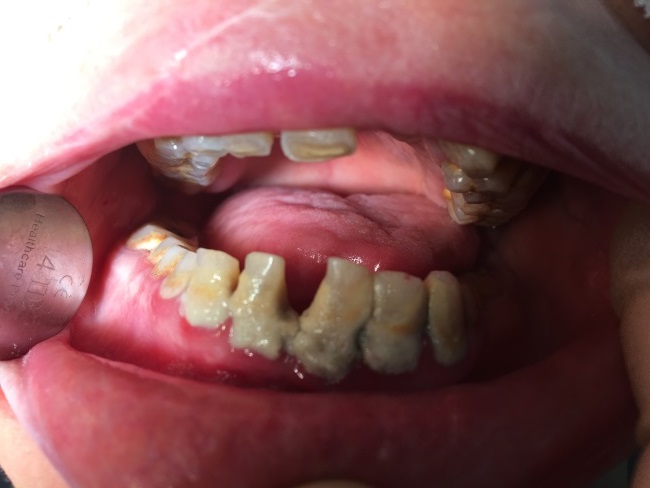 A picture paints a 1000 words.

This is why we've needed a revolution in dentistry in care homes. 

Now hard-won progress risks being lost by an unparalleled access crisis.

These are our most vulnerable patients.

Ministers have a moral duty to act.

👉  bda.org/news-centre/la…