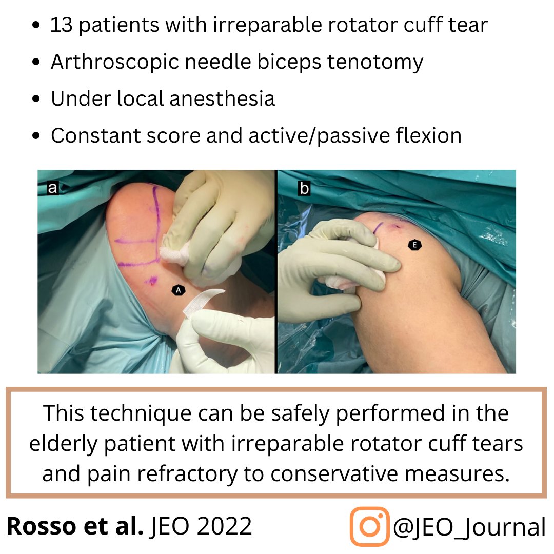 JEO_journal's tweet photo. Long head of the biceps intra-articular tenotomy using needle arthroscopy!!
How to do it?
Let's take a look at this OPEN ACCESS article: 10.1186/s40634-022-00508-5
#tenotomy #biceps #arthroscopy #needlearthroscopy #rotatorcufftear https://t.co/3aFvSwVxsY