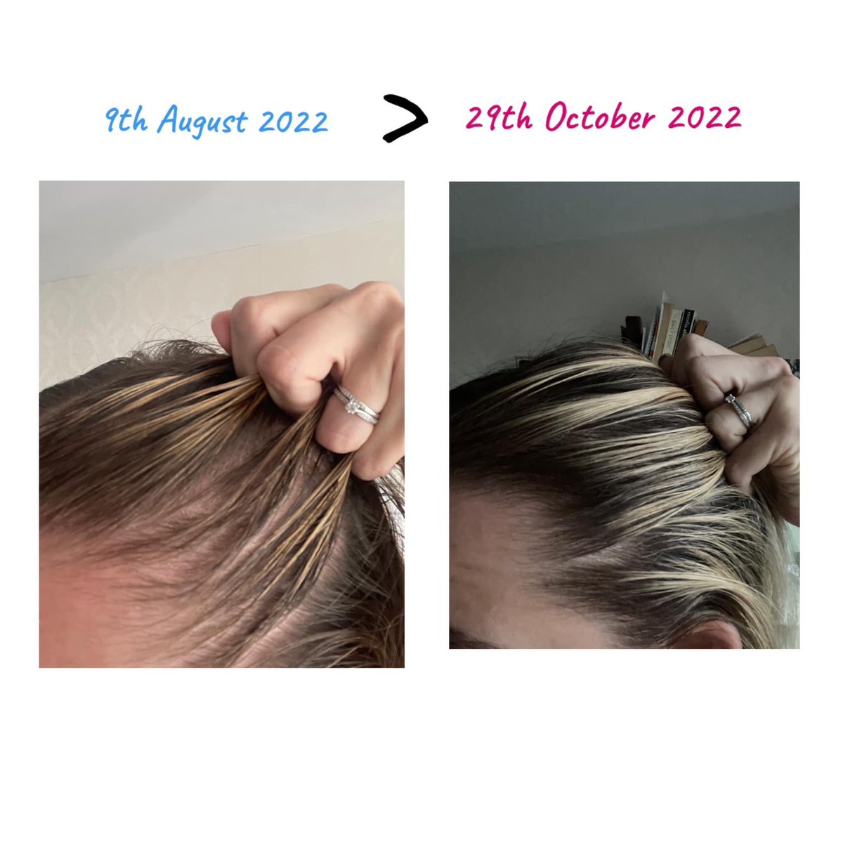 EllieMyhill's tweet photo. 𝐖𝐨𝐰 𝐎𝐦𝐞𝐠𝐚 𝐌𝐚𝐠𝐢𝐜 🍊💛🧡

How incredible are these hair results from our omegas 😱🙌

If you have hair growth problems I’d love to help 😙 

DM me for info📥 https://t.co/D2Ee7Vl4Kd