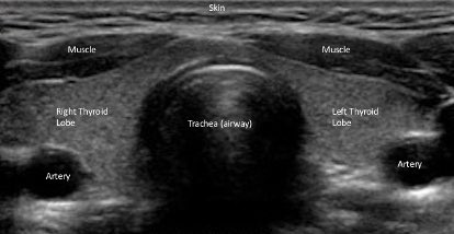APierroMedicine's tweet photo. Here is a labeled diagram of a thyroid ultrasound. Contrary to popular belief, ultrasounds are not just used on pregnant women! They can be used to screen patients for abnormalities in various parts of the body. https://t.co/vtKH4KmOBV