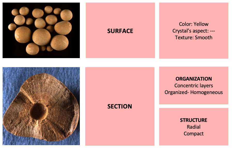 How to describe a urinary stone? During endoscopic procedures look at its surface and section to better refine its origin. #Uricacid #lithiasis #endourology