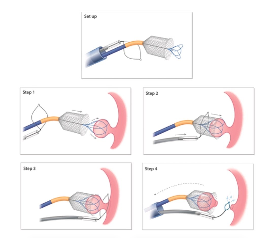 The Simplified Extraction of Atrial Tumor With Targeted Loop Electricity (SEATTLE) Procedure

An alternative to either surgical excision or watchful waiting in patients with small- to medium-sized intracardiac tumors.

By Zachary L. Steinberg et al.
jacc.org/doi/10.1016/j.…