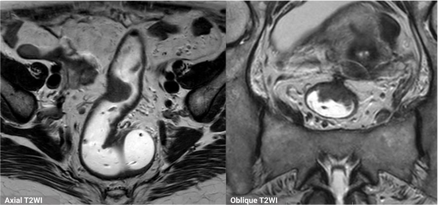 [1/4] 59F with rectal tumor. Initial assessment. 
Which T-stage does it correspond? It is a locally advanced rectal tumor (T3/T4)  or not? 
Keep reading! 👇

<a href="/LapsiaSnehal/">Snehal Lapsia</a> <a href="/danatsouza/">Daniel Souza</a> <a href="/DrVikasShah/">(𝚝𝚑𝚎𝚡𝚛𝚊𝚢𝚍𝚘𝚌𝚝𝚘𝚛)</a> <a href="/abdo_imaging/">sharad maheshwari MD</a>

#Radres #FOAMrad