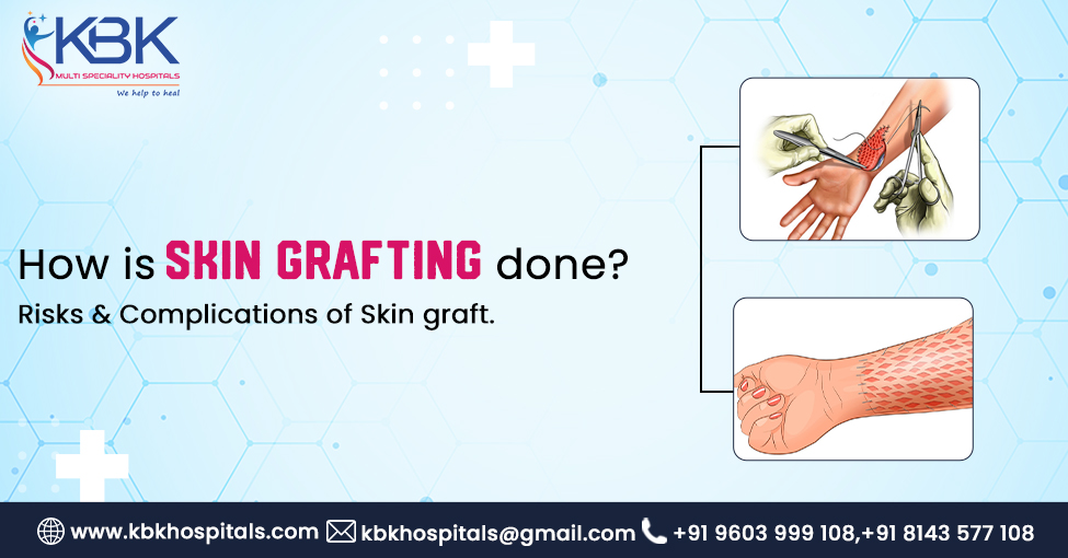 kbkhospitals's tweet image. #Skingrafting is a remarkable surgical technique where healthy skin embarks on a journey from one part of your body to another, heroically rescuing damaged or missing skin.

Link to know more in detail about #skin #grafts;
bit.ly/3LTbJiH 

Contact us@ +91 9603999108.