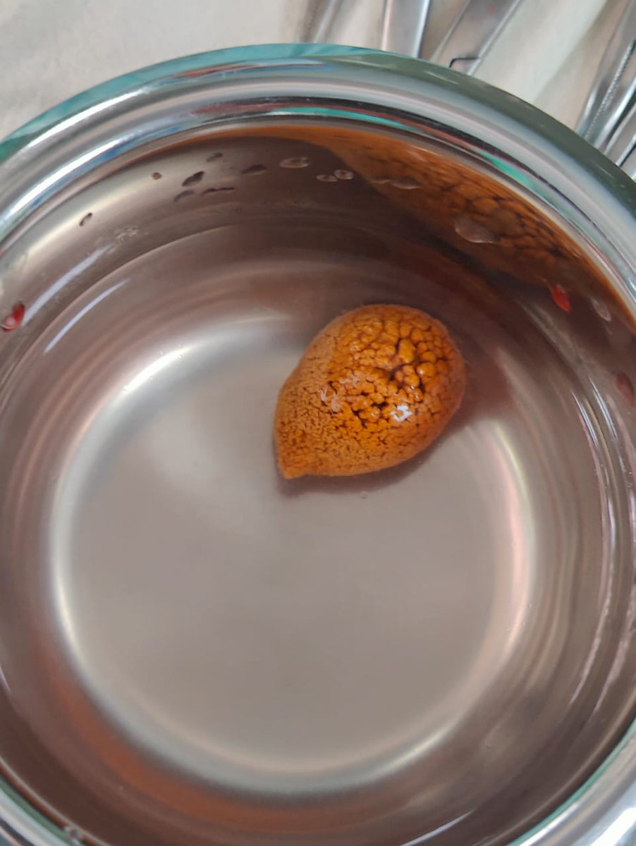 rajeevmenonsl's tweet photo. Today we removed a #bladder stone that was 2.5cm x 1.8 cm from a 45 yr old healthy man. Below are the real images of the stone we removed. Thought of sharing some information on bladder calculi 🧵 
#MedTwitter #bladdercalculi #bladderstone #srilanka #lka
1/10 https://t.co/TXffZbqR2I