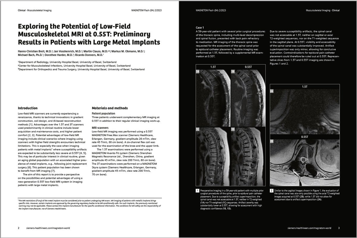 Exploring the Potential of Low-Field Musculoskeletal #MRI at 0.55T: Preliminary Results in Patients with Large Metal #Implants by Hanns-Christian Breit, MD; et al. (<a href="/UniSpitalBasel/">UniSpitalBaselCH</a>, Switzerland). Learn more at …ng.webassets.siemens-healthineers.com/44848359f2a4ad…
#magnetomworld #MSK #LowFieldMRI