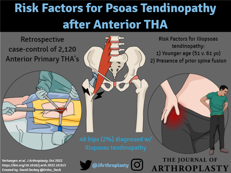 JArthroplasty's tweet photo. There is an incidence of 2.2% of iliopsoas tendinopathy patients after DA #THA that compromised outcomes. @womenAAHKS @BrdgPlt2Nowhere @alexusmcooper @CenterRotation @kimtuckinAZ @DrPeterGold @KevinWeiszMD 

https://t.co/beS3JAktCZ

#VA by @Ortho_Deck https://t.co/VbjK2oQlUB