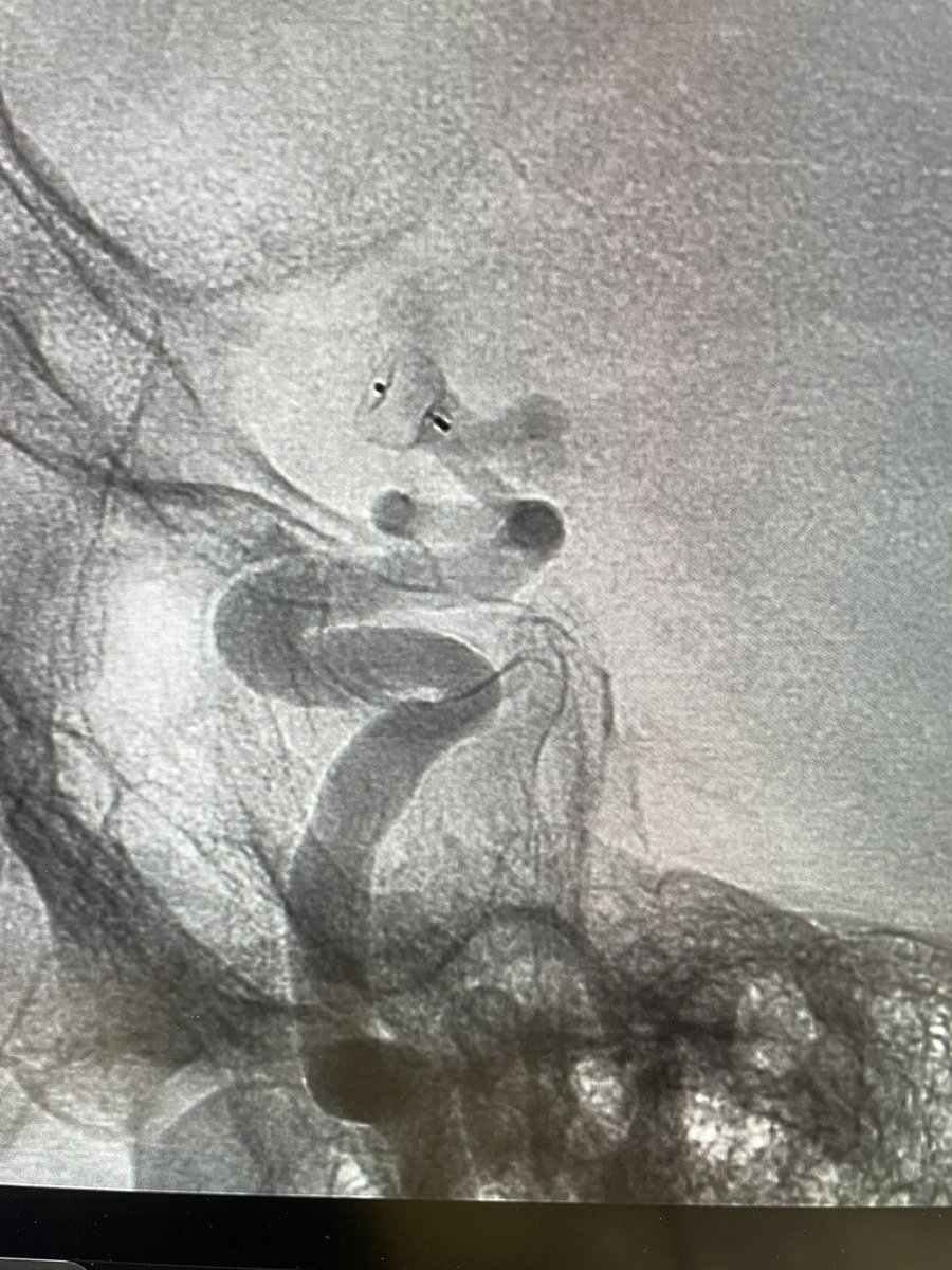 ✅ First WEB at Paoli Hospital! Many thanks to <a href="/StavTjoumakaris/">Stavropoula Tjoumakaris MD, MBA, FAANS, FACS, FAHA</a> 🙌🏻 World class neurovascular care in the community. <a href="/TJUHNeurosurg/">Jefferson Neurosurgery</a> <a href="/TJUHospital/">Jefferson Health</a> <a href="/mainlinehealth/">Main Line Health</a> @MV_Terumo