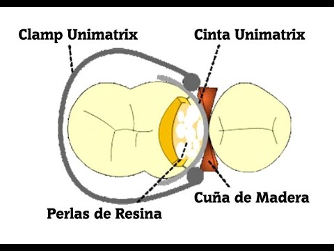 OviDentalGo's tweet image. VIDEO youtu.be/yBBMtp-4lW4
Colocación de Perlas de resina paso a paso

#ResinaCompuesta #Ovidental