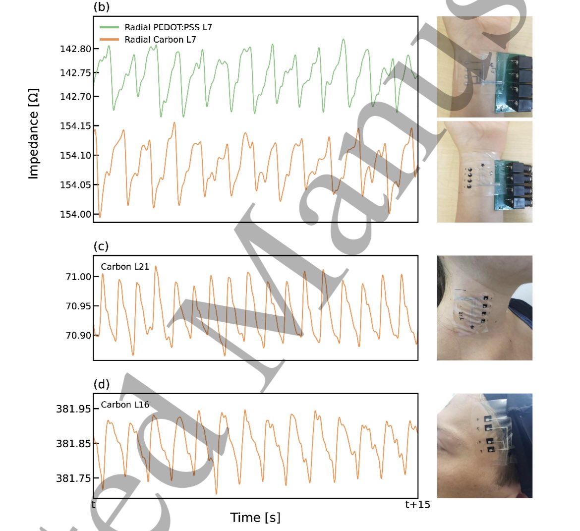 Small dry electrode arrays outperform gel electrodes in bioimpedance measurements. Don’t believe it? Checkout: Printed soft skin electrodes for seamless bio-impedance measurements. iopscience.iop.org/article/10.108…