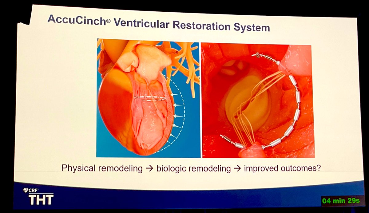 Transcatheter Restoration of the Dilated LV in Symptomatic HFrEF Patients: The Next Frontier in HF Treatment After GMT Optimization? The AccuCinch Approach. Cohort M12 results. 
🎯Favorable safety profile
🎯 Signifiant and progressive reverse remodeling (LVEDV)
🎯 Improved QOL